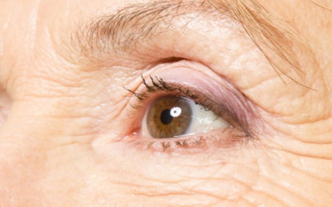 Prevenció d’arrugues causades per la contracció muscular