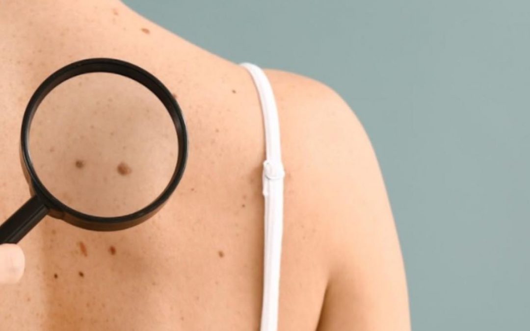 Pigues a la pell. Com i quan tractar-les