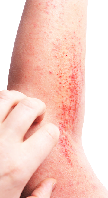 Dermatits general | Dermatitis atòpica